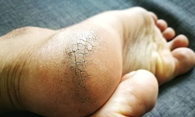 ಚಳಿಗಾಲದಲ್ಲಿ ಪಾದಗಳ ಆರೈಕೆ ಹೀಗಿರಲಿ