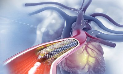 ಅನಿವಾಸಿ ಭಾರತೀಯರಿಗೆ ರೋಬೋಟಿಕ್ ಹಾರ್ಟ್ ಬೈಪಾಸ್