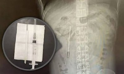 ಮಗುವಾಗಿದ್ದಾಗ ನುಂಗಿದ್ದ ಥರ್ಮಾ ಮೀಟರ್ 20 ವರ್ಷಗಳ ಬಳಿಕ ಹೊರತೆಗೆದ ವೈದ್ಯರು