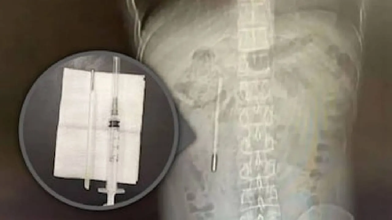 20 ವರ್ಷಗಳವರೆಗೆ ವ್ಯಕ್ತಿಯ ಹೊಟ್ಟೆಯಲ್ಲಿದ್ದ ಥರ್ಮಾ ಮೀಟರ್!