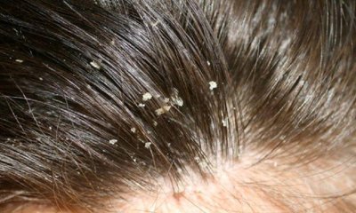 ಬೇಸಿಗೆಯಲ್ಲಿ ತಲೆಹೊಟ್ಟಿನ ನಿವಾರಣೆ ಹೇಗೆ?