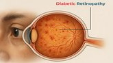 ಮಧುಮೇಹದ ರೆಟಿನೋಪತಿ: ಆರೋಗ್ಯ ವ್ಯವಸ್ಥೆಯ ಮುಂದಿರುವ ಸವಾಲು
