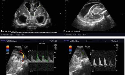 1,000 ಟ್ರಾನ್ಸ್‌ ಕ್ರೇನಿಯಲ್ ಡಾಪ್ಲರ್ ಪ್ರಕ್ರಿಯೆ ಪೂರ್ಣ