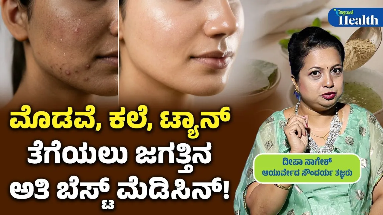 ಬೇಸಗೆಯಲ್ಲಿ ಮುಖದ ಮೊಡವೆ, ಟ್ಯಾನ್ ರಿಮೂವ್ ಮಾಡುವ ಸುಲಭ ಕ್ರಮ ಇಲ್ಲಿದೆ