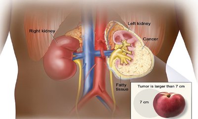 72 ವರ್ಷದ ಮಹಿಳೆಗೆ ಯಶಸ್ವಿ ಚಿಕಿತ್ಸೆ