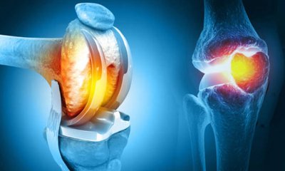 ಮೊಣಕಾಲು ಬದಲಾವಣೆ ಶಸ್ತ್ರಚಿಕಿತ್ಸೆಯಿಂದ 48 ವರ್ಷದ ವ್ಯಕ್ತಿಗೆ ಹೊಸ ಜೀವನ