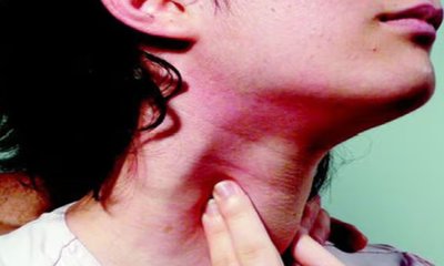 ಕ್ಲಿಷ್ಟಕರ ಥೈರಾಯ್ಡ್ ಗೆಡ್ಡೆಗೆ ಶಸ್ತ್ರಚಿಕಿತ್ಸೆ ಮೂಲಕ ಯಶಸ್ವಿ ಚಿಕಿತ್ಸೆ