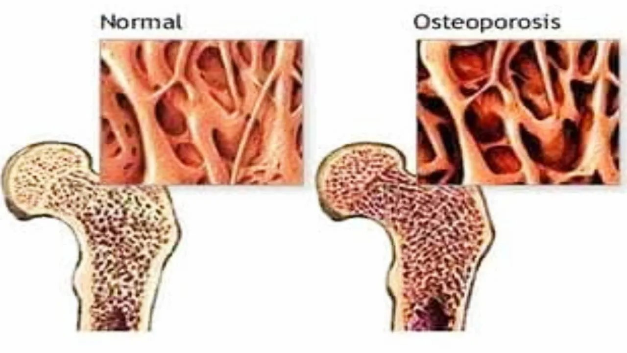 Osteoporosis