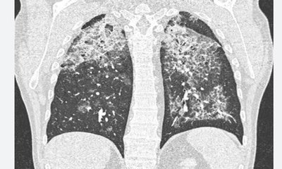 ಮಹಿಳೆಯಲ್ಲಿ ಪಲ್ಮನರಿ ಅಲ್ವಿಯೋಲಾರ್‌ ಪ್ರೊಟಿನೋಸಿಸ್‌" ಪತ್ತೆ