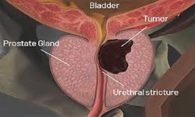 ಆಹಾರದ ಬದಲಾವಣೆಯು ಪ್ರೊಸ್ಟೇಟ್ ಕ್ಯಾನ್ಸರ್ ಹೆಚ್ಚಳಕ್ಕೆ ಕಾರಣ
