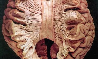 ಆಲ್ಬರ್ಟ್ ಐನ್‌ಸ್ಟೀನ್ʼರ ಮಿದುಳನ್ನು ಕತ್ತರಿಸಿದಾಗ...