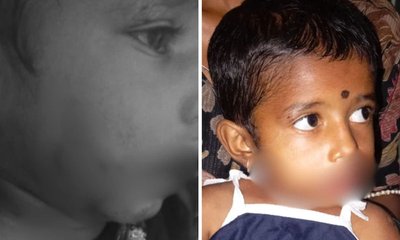 4 ವರ್ಷದ ಬಾಲಕಿಯ ಮೇಲೆ ಬೀದಿ ನಾಯಿಗಳ ದಾಳಿ