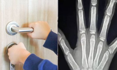 ಶಾಲೆಯ ಬಾಗಿಲಿಗೆ ಸಿಲುಕಿ ತುಂಡಾದ ವಿದ್ಯಾರ್ಥಿನಿಯ ಕೈ ಬೆರಳು