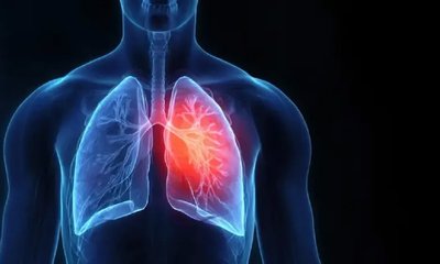 ಬೆಂಗಳೂರಿನಲ್ಲಿ ಹೆಚ್ಚುತ್ತಿರುವ ವೈರಲ್ ಉಸಿರಾಟದ ಸೋಂಕು