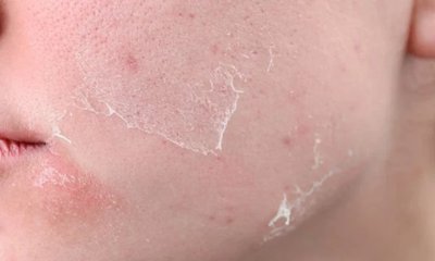 Vishweshwar Bhat Column: ಮುಖದ ಮೇಲಿನ ಕಲೆ ಪರಿಣಾಮ