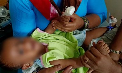 6 ತಿಂಗಳ ಮಗುವಿನ ಬೆರಳನ್ನೇ ಕತ್ತರಿಸಿದ ನರ್ಸ್