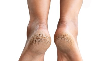 ಹಿಮ್ಮಡಿ ಒಡಕಿನಿಂದ ಸಮಸ್ಯೆ ಅನುಭವಿಸುತ್ತಿದ್ದೀರಾ? ಇಲ್ಲಿದೆ ಪರಿಹಾರ