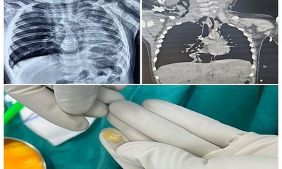 ಉಸಿರಾಟದ ಸಮಸ್ಯೆಗೆ ಒಳಗಾದ 10 ತಿಂಗಳ ಮಗು- ಕೆಎಂಸಿ ವೈದ್ಯರಿಂದ ರಕ್ಷಣೆ