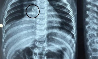 ಮಗುವಿನ ಶ್ವಾಸನಾಳದಲ್ಲಿತ್ತು ಎಲ್ಇಡಿ ಬಲ್ಬ್