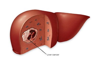 ಯಕೃತ್ ಕ್ಯಾನ್ಸರ್ ಅಪಾಯ ತಪ್ಪಿಸಲು ಸರಿಯಾದ ಕೊಬ್ಬನ್ನು ಆರಿಸಿ
