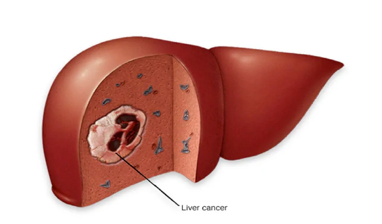 Liver Cancer: ಸ್ಥೂಲತೆಯು ಹೆಚ್ಚುತ್ತಿರುವ ಜಗತ್ತಿನಲ್ಲಿ ಯಕೃತ್ ಕ್ಯಾನ್ಸರ್ ಅಪಾಯ ಕಡಿಮೆ ಮಾಡಲು ಸರಿಯಾದ ಕೊಬ್ಬನ್ನು ಆಯ್ಕೆ ಮಾಡೋಣ