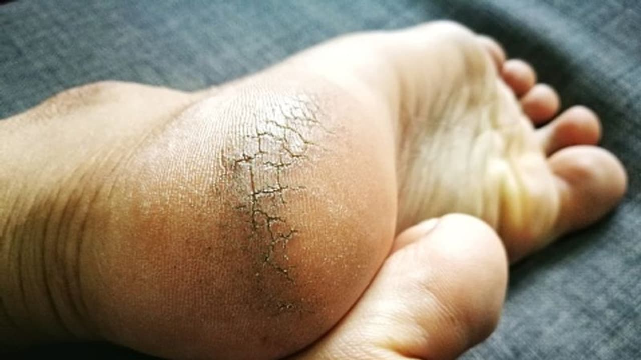 ಚಳಿಗಾಲದಲ್ಲಿ ಪಾದಗಳ ಆರೈಕೆ ಹೀಗಿರಲಿ