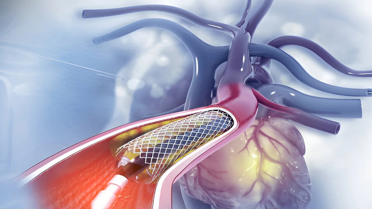 ಅನಿವಾಸಿ ಭಾರತೀಯರಿಗೆ ರೋಬೋಟಿಕ್ ಹಾರ್ಟ್ ಬೈಪಾಸ್