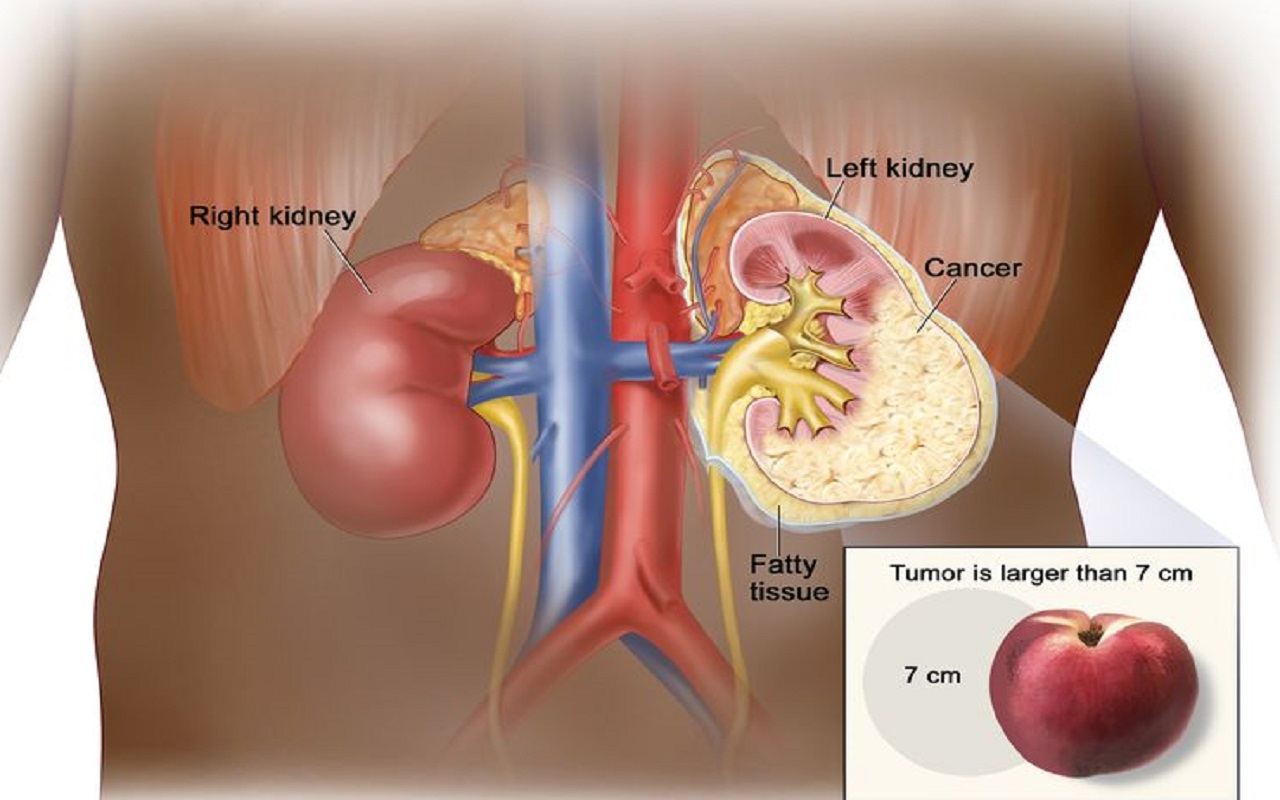 72 ವರ್ಷದ ಮಹಿಳೆಗೆ ಯಶಸ್ವಿ ಚಿಕಿತ್ಸೆ