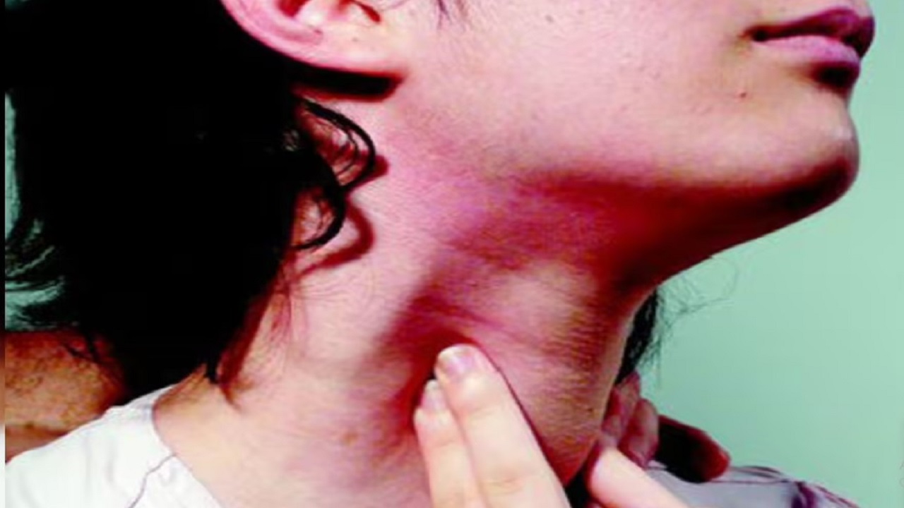 ಕ್ಲಿಷ್ಟಕರ ಥೈರಾಯ್ಡ್ ಗೆಡ್ಡೆಗೆ ಶಸ್ತ್ರಚಿಕಿತ್ಸೆ ಮೂಲಕ ಯಶಸ್ವಿ ಚಿಕಿತ್ಸೆ