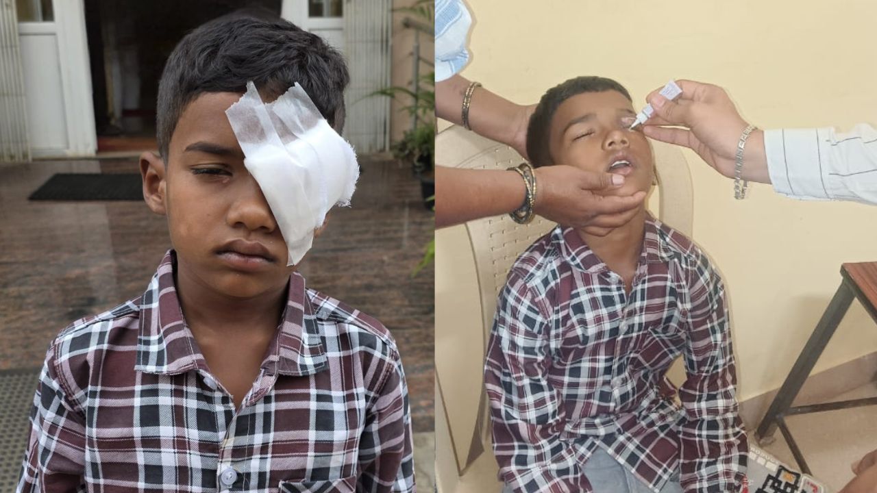 ಪಟಾಕಿಯಿಂದ ಗಾಯ; ಬಾಲಕನ ದೃಷ್ಟಿ ಉಳಿಸಿದ ಶಾರದಾದೇವಿ ಆಸ್ಪತ್ರೆ ವೈದ್ಯರು