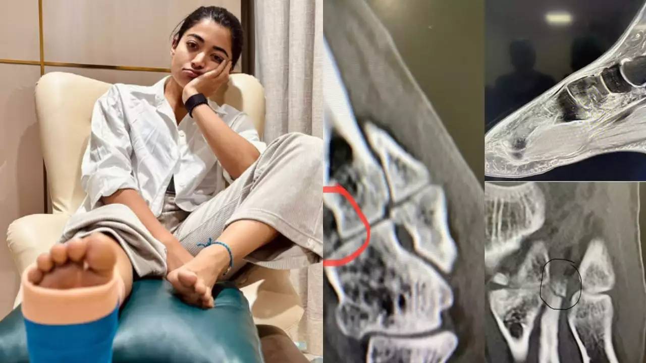 Rashmika Mandanna: ಮುರಿದ ಕಾಲಿನ ಎಕ್ಸ್ ರೇಯ ಫೋಟೋ ಹಂಚಿಕೊಂಡು ಕಣ್ಣೀರು ಹಾಕಿದ ನ್ಯಾಶನಲ್ ಕ್ರಶ್