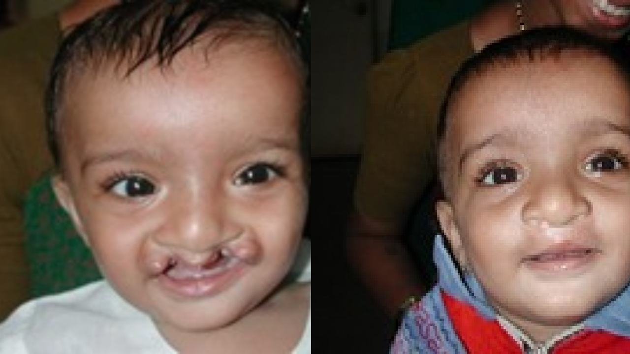 Cleft lip: ಪಾಲಕರನ್ನು ಭಯಕ್ಕೀಡು ಮಾಡುವ ಸೀಳುತುಟಿ: ಇದಕ್ಕೂ ಇದೆ ಪರಿಹಾರ!