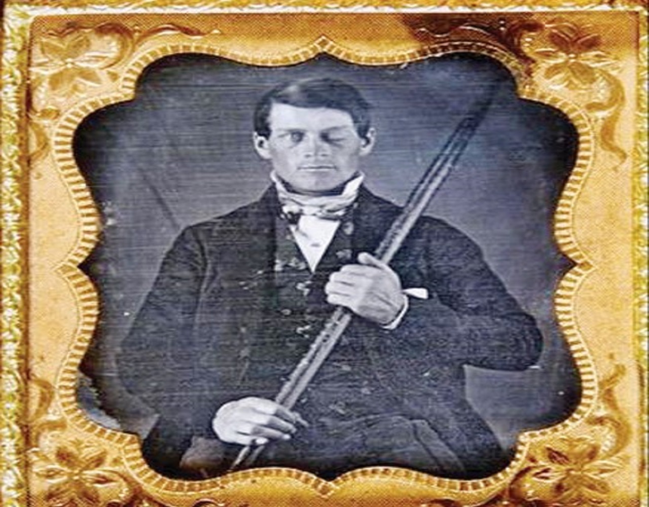 ಸಿಡಿಮದ್ದು ಸ್ಫೋಟಕ್ಕೆ ಕಬ್ಬಿಣದ ಸರಳು ಮಿದುಳನ್ನು ಹೊಕ್ಕಿತು !