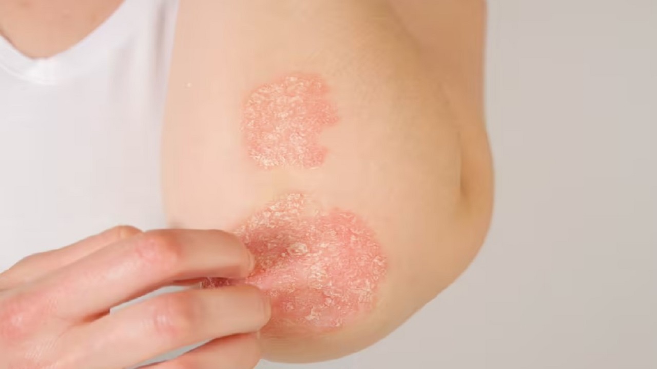 ಬಾಲಕಿಯ ದೀರ್ಘಕಾಲದ ಎಕ್ಸಿಮಾ ಸಮಸ್ಯೆಗೆ ಯಶಸ್ವಿ ಚಿಕಿತ್ಸೆ