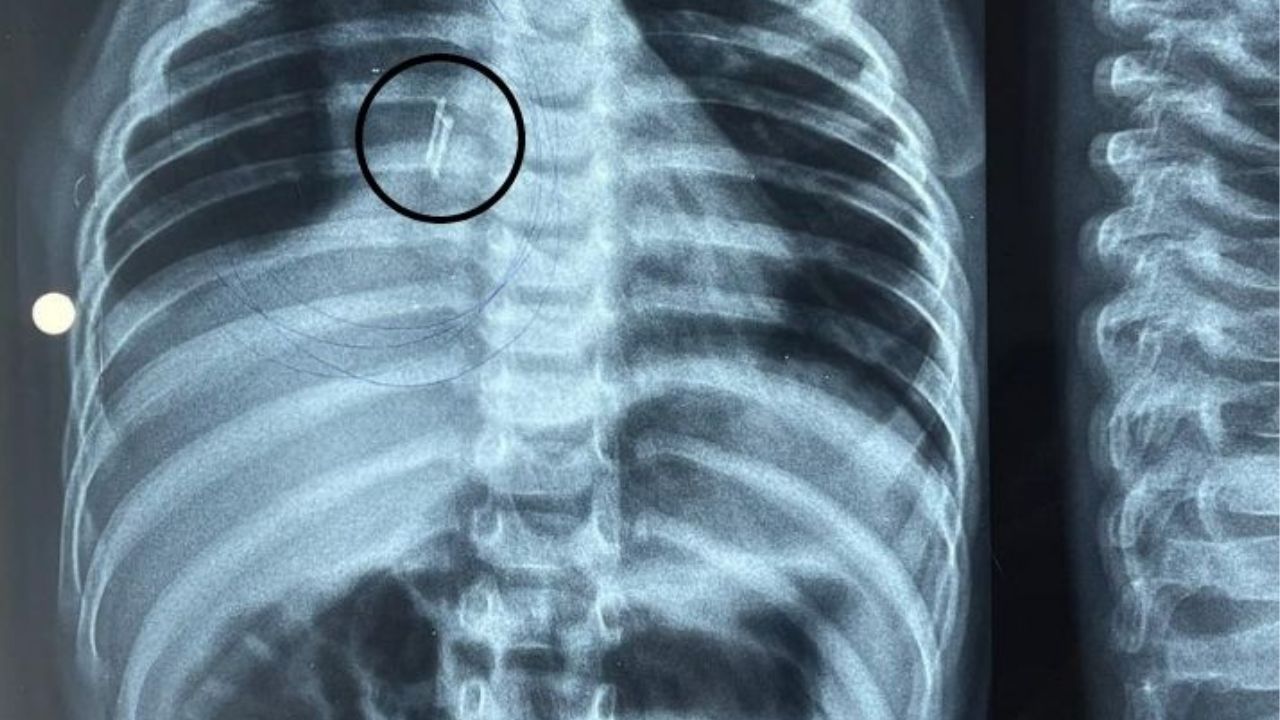 ಮಗುವಿನ ಶ್ವಾಸನಾಳದಲ್ಲಿತ್ತು ಎಲ್ಇಡಿ ಬಲ್ಬ್