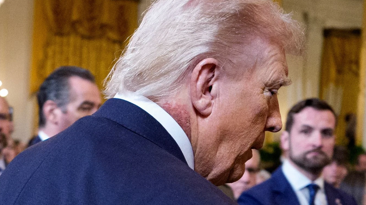 ಡೊನಾಲ್ಡ್ ಟ್ರಂಪ್ ಗೆ ಕಾಡುತ್ತಿದೆಯೇ ಅನಾರೋಗ್ಯ ?