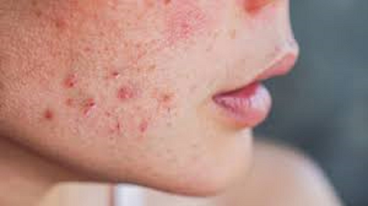 ಚಳಿಗಾಲದಲ್ಲಿ ಚರ್ಮ ಒಣಗುತ್ತಿದೆಯೇ? ಆಹಾರ, ಸ್ಕಿನ್ ಕೇರ್ ಕಾರಣವಾಗಿರಬಹುದು